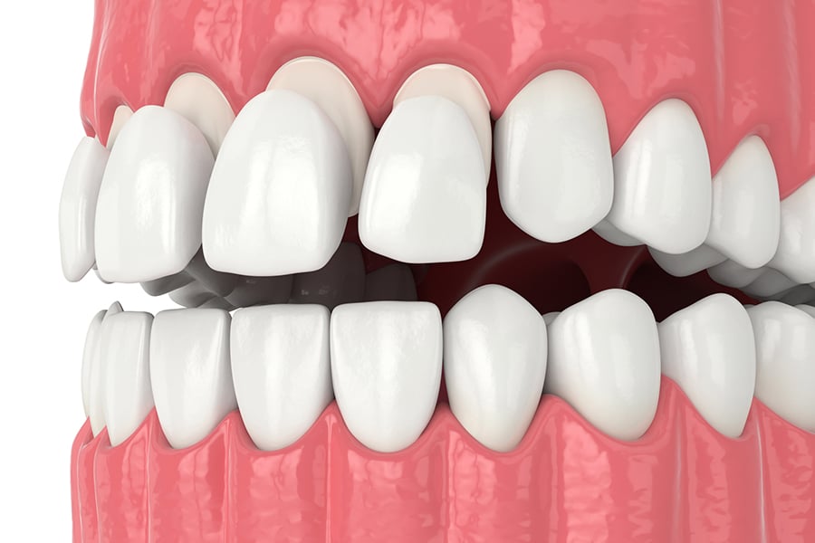 Composite Veneers: Are They Worth It? | EVDP