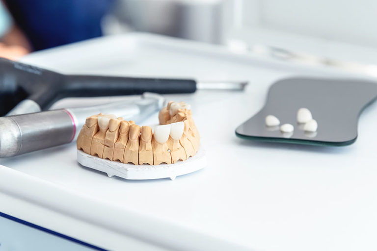 Ceramic vs Porcelain Crowns | East Valley Dental Professionals