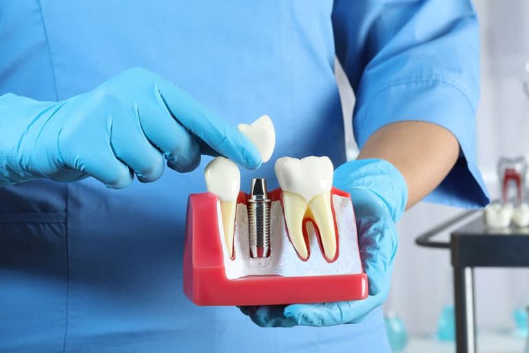 What Dental Insurance Covers Crowns | EVDP