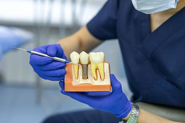 Dental Implants vs Crowns | East Valley Dental Professionals