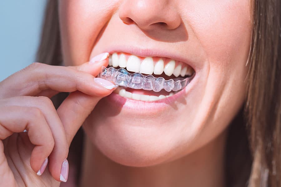 Clear Braces - Nearly Invisible Teeth Straightening for White